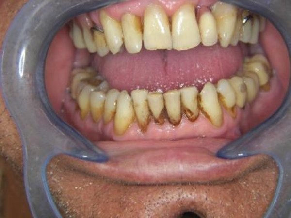 Réparation des incisives mandibulaires par facettes
