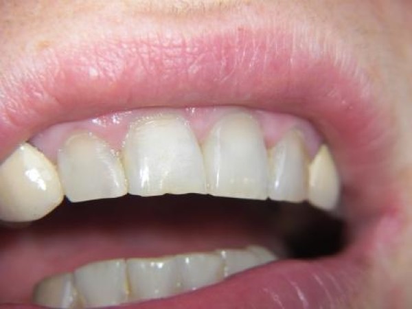 Couronne dentaire avant - après : Auriol, proche Aubagne