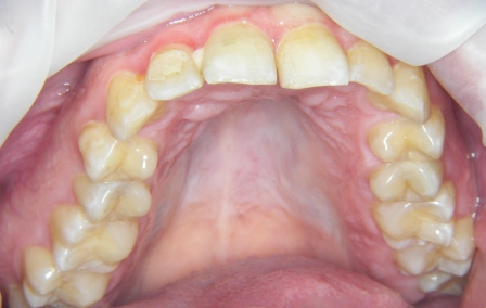 Orthodontie adulte par gouttière3-Haut départ