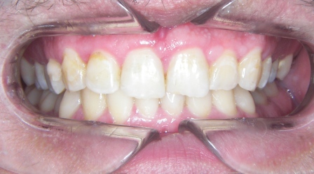 Orthodontie adulte par gouttière 2-Face finie