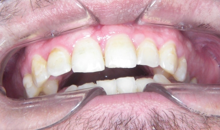 Orthodontie adulte par gouttière 4-Haut fini